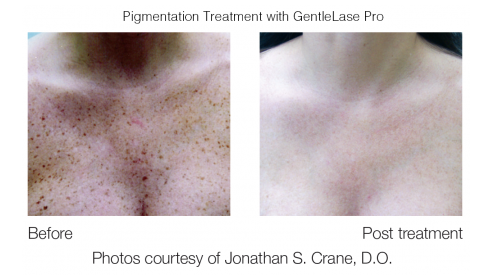 Rejuvenation of the Chest and Décolletage