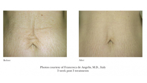 Laser Skin Tightening Before And After